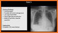 Chest X-Ray Interpretation related image