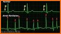 Atrial fibrillation related image