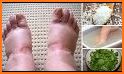 SWOLLEN FEET HOME REMEDIES related image