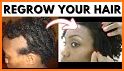 How to get rid of Alopecia related image