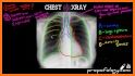 Easy Chest X-Ray related image