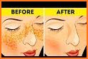 Acne Scar Removal Tips and Tricks related image