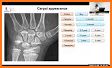 Bone Age Calculator related image