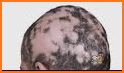 How to get rid of Alopecia related image