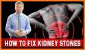 Stone MD — Kidney stones related image