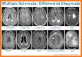 Understanding MRI: Multiple Sclerosis related image