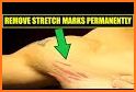 Get Rid of Body Stretch Marks related image