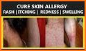 Home Remedies For Skin Allergy related image