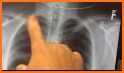 Easy Chest X-Ray related image