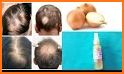 Alopecia Treatment- Home Remedies For Hair Growth related image