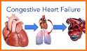 Congestive Heart Failure related image